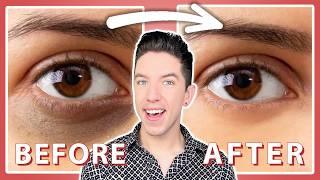 How to Get Rid of Dark Circles & Spots (2024)