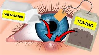 How To Get Rid of a Stye Overnight (USING SALT-WATER & TEABAGS)