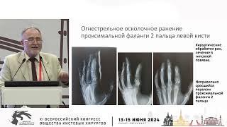 Обухов И.А.: технологии оперативного лечения открытых и огнестрельных повреждений костей кисти.