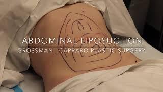 ABDOMINAL LIPOSUCTION