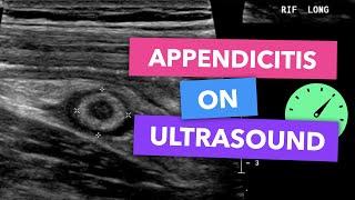 Appendicitis on ultrasound - Radiopaedia's Emergency Radiology Course