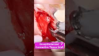 De-epithelialized Connective Tissue Graft #dentalimplants #implantdentist #connectivetissue