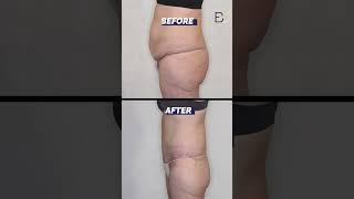 Belt Lipectomy Before and After (Patient 2020-1024) #shorts