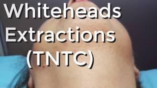 Whiteheads Extraction (TNTC) - Session I - Part 1