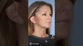 Amazing before and after from #necklift & #facelift by Dr. Kevin Sadati #plasticsurgery