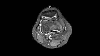 Avulsive Cortical Irregularity (Cortical Desmoid)