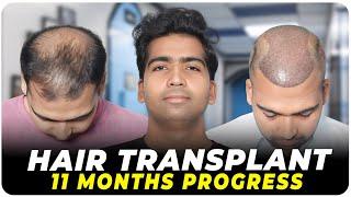 Hair Transplant in India | Best Results & Cost of Hair Transplant in India