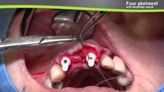 AnyRidge Immediate Load Case with Mega ISQ & Fuse Abutment