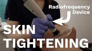 The BEST devices for Skin Tightening | Dr Davin Lim