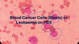 How to identify blasts on Peripheral Blood Smear |  Blood Cancer Cells |  Leukemia