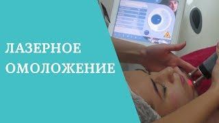 Лазерное омоложение лица