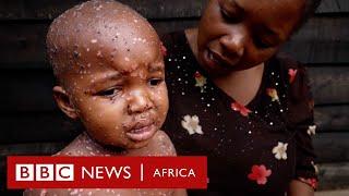 Mpox: Children bearing the brunt - BBC Africa