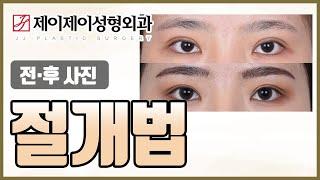 절개법 전후영상 - 제이제이성형외과 #shorts