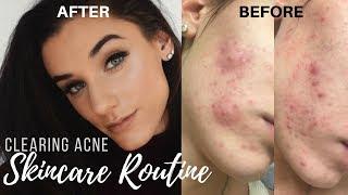 Clearing Up Acne | My Skin Care Routine || KelseyG