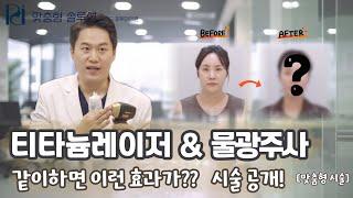 【맞춤형 시술】티타늄레이저&물광주사 같이하면 이런 효과가? 시술 공개!!