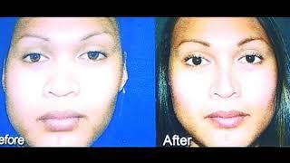 Asian Rhinoplasty Honolulu - Dr  Benjamin Chu