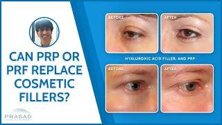 Why PRP or PRF Cannot Replace Dermal Fillers