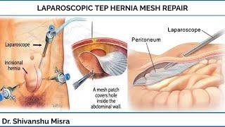 LAPAROSCOPIC TEP HERNIA MESH REPAIR | DR SHIVANSHU MISRA