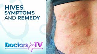 Hives Symptoms and Remedy | DOTV