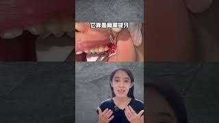 人生中第一次手術好緊張？拔智齒可能沒你想像恐怖#手術拔牙#簡單拔牙