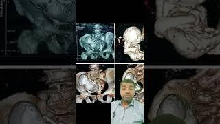 Doctor reacts to stone baby!!!! lithopedion