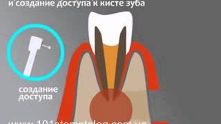 Хирургическое лечение кисты зуба. 101stomatolog.com.ua