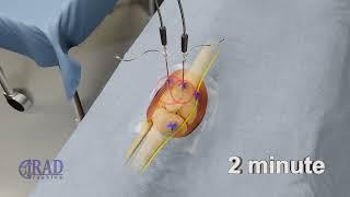 Genicular nerve ablation