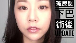 玻尿酸下巴療程術後注意事項、保養＆三個月後的心得｜Mioggi Juvederm facial filler treatment Post-Op Update｜Nabibuzz娜比