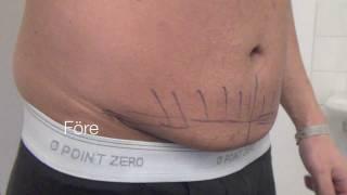 Bukplastik liten 271 g 2 veckor Primakliniken Plastikkirurgi Tummy tuck