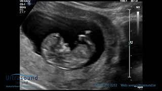 Scan of the Week: 12 Week Advanced Early Scan