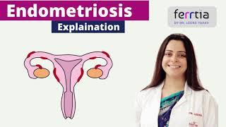 Endometriosis (en-doe-me-tree-O-sis)