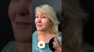 Привели в порядок шею после пластики лица #платизмопластика
