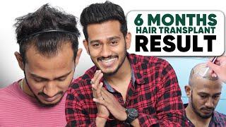 Hair Transplant in India | Best Results & Cost of Hair Transplant in India