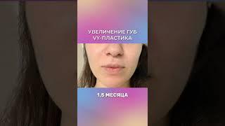 Реабилитация после пластики губ / VY-пластика / Грецкова Евгения Евгеньевна