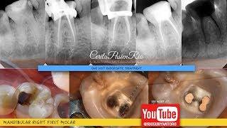 one visit endodontic treatment prior to crown rebilda dc x-tra base spesialis konservasi gigi