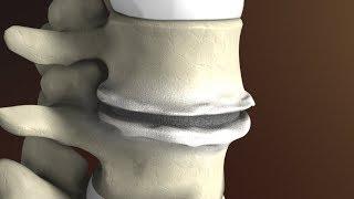 Degenerative Disc Disease (Spondylosis) explained by Spine Surgeon Dr. Jessica Shellock Plano, TX