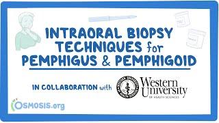 Intraoral Biopsy Techniques for Pemphigus & Pemphigoid (in Collaboration w/ Western University)