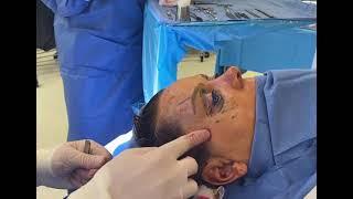 Lateral Brow Lift by Daniel Krochmal, Plastic Surgeon