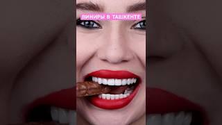 Виниры в ташкенте | Стоматолог Ташкент