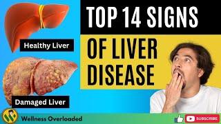 Top 14 Signs of Liver Disease