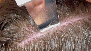 Scalp Treatment for Dandruff/Buildup