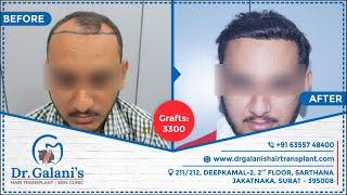 Best Hair Transplant In Surat 2021 | Fue - No Root Touch Surgery | Before And After 3300 Grafts