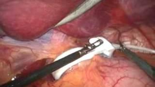 Laparoscopic Gastric banding by Dr Craig Taylor of OClinic.mov