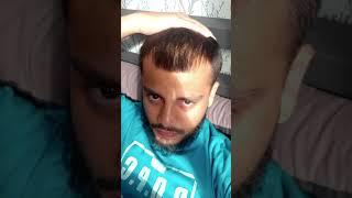 2 Year Hair Loss Transformation #baldcafe