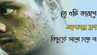 যে ৫টি কারণে আপনার ব্রণ কিছুতেই ভালো হচ্ছে না | 5 Big Reasons You Have Pimples | Get Rid of Pimples