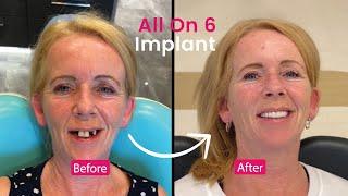 Angela's incredible transformation with all-on-6 implants at Elite Dental Clinic in Kuşadası!