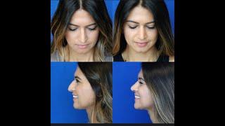 An amazing Septorhinoplasty by dr. Ali sajjadian|Balanced rhinoplasty in Newport Beach