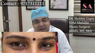 What is Xanthelasma Removal Treatment | Dr. Shobhit Gupta Xanthelasma Laser Removal Before and After