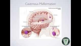 CTH Cavernous Malformation