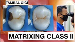 Step by Step Matrixing Class II Premolar | General Dentist Griya RR